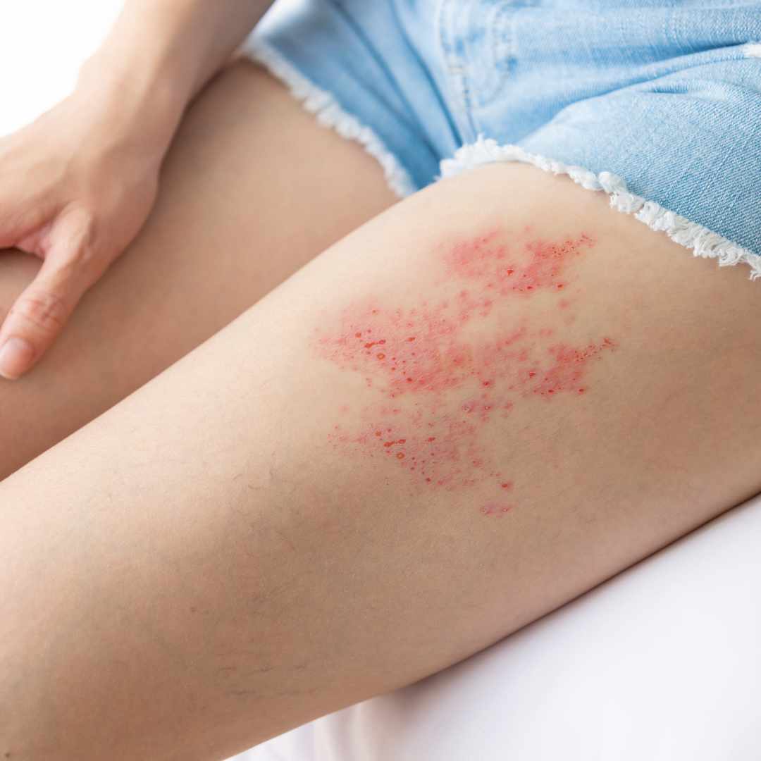 Person med rødt og smertefuldt udslæt på låret som er typisk for herpes zoster og kan lindres med effektiv helvedsild behandling.